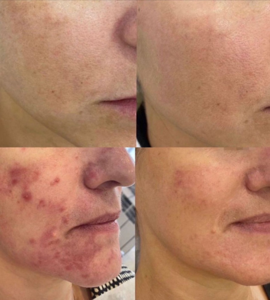 пилинг2 пилинг2